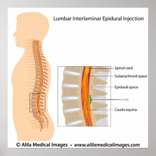 Póster Injeção epidural lombar, diagrama marcado.