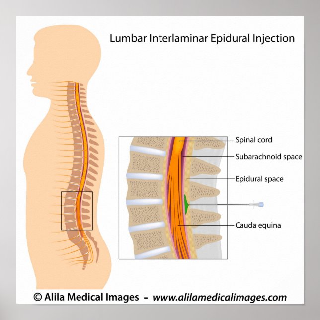 Póster Injeção epidural lombar, diagrama marcado. (Frente)