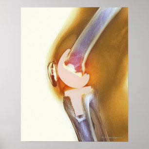 Póster Knee replacement. Coloured X-ray of a total knee