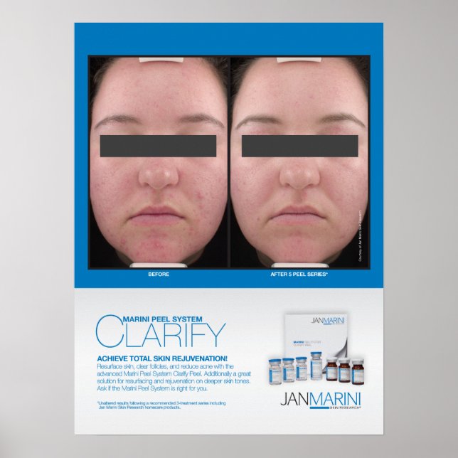 Póster Marini Peel Clarify Resultados 18x24" (Frente)