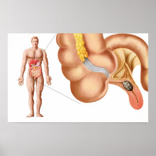 Póster Medical Ilustration Of An Appendix