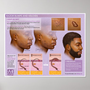 Poster Médico Melalogico de Razor e Keloids
