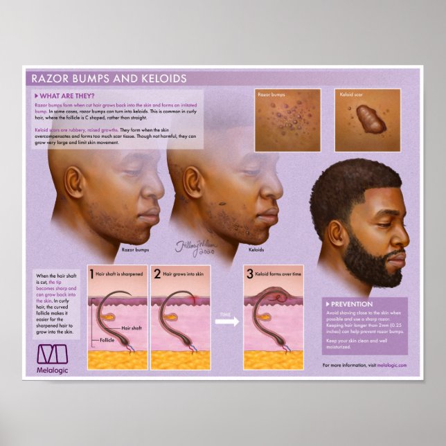 Poster Médico Melalogico de Razor e Keloids (Frente)