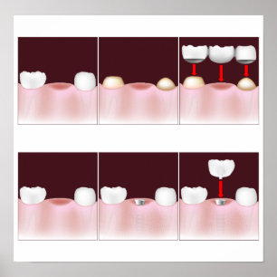 Poster Os implantes dentais contra ponte fixa, adicionam