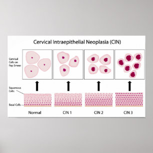 Póster Palcos de displasia do colo do útero e teste de Pa