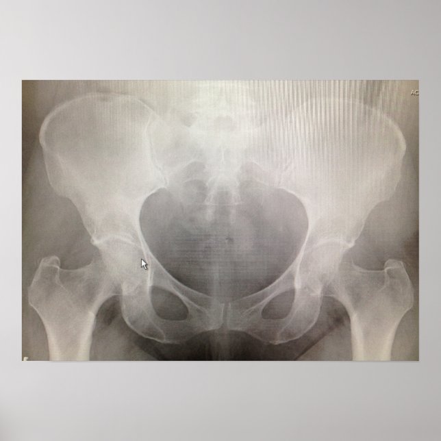 Póster Pelvis X-ray (Frente)