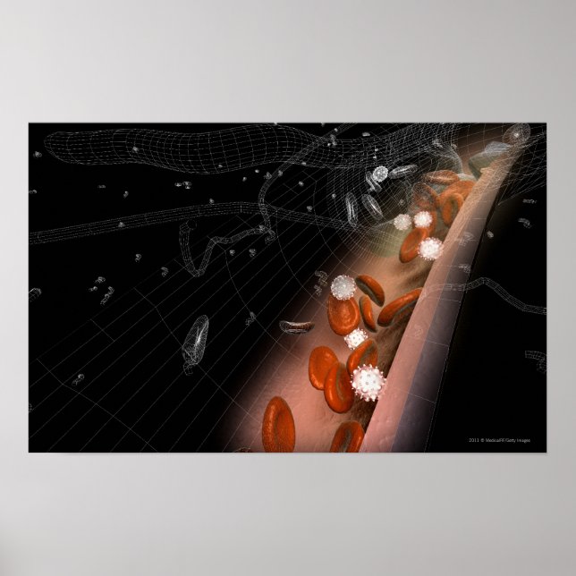 Póster Placa nas artérias (Frente)