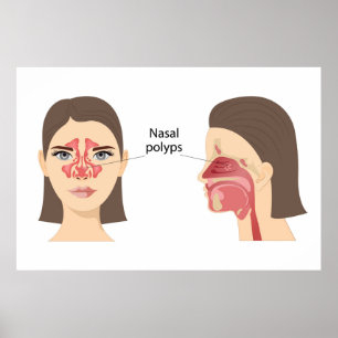 Poster Polos nasais