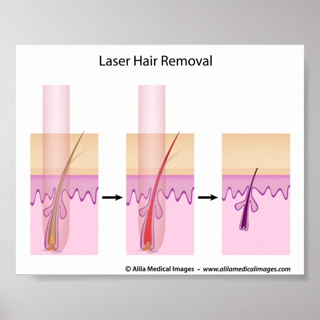 Póster Procedimento de remoção de cabelo laser (Frente)