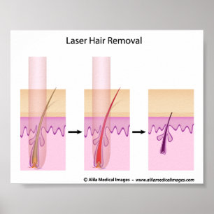 Póster Procedimento de remoção do cabelo do laser
