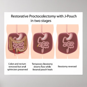 Póster Proctocolectomia reativa com palcos j-pouch 2