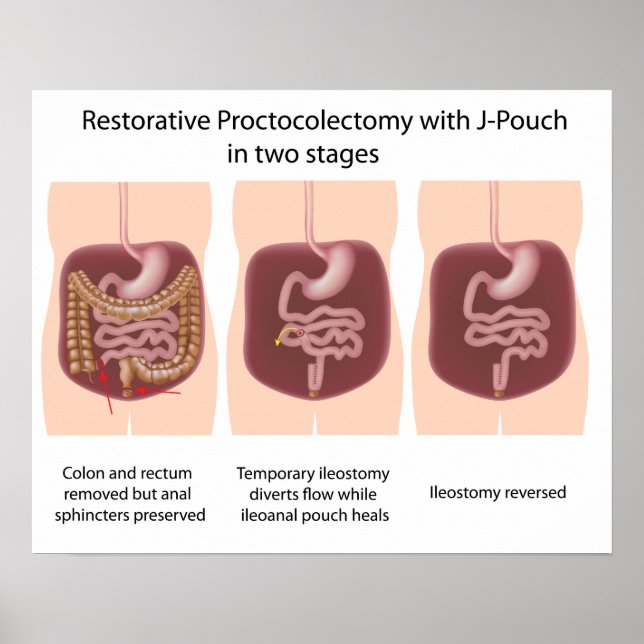 Póster Proctocolectomia reativa com palcos j-pouch 2 (Frente)