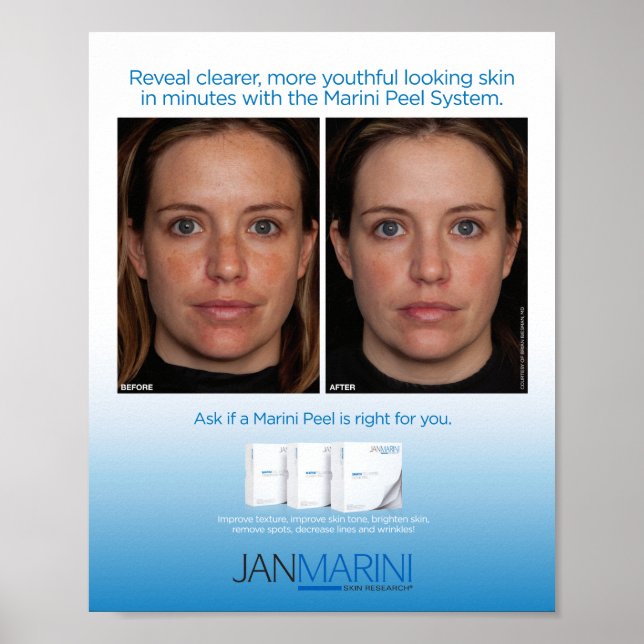 Póster Sistema Marini Peel 8x10" (Frente)