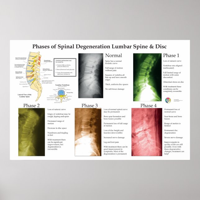 Poster Spinal Degeneration Lumbar Spine Chiropractic (Frente)