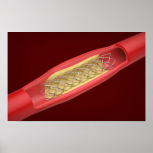 Poster Stent médico dentro do vaso sanguíneo