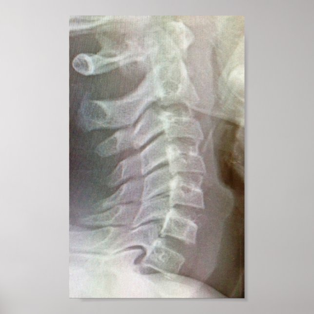 Póster Torneio da coluna cervical (Frente)