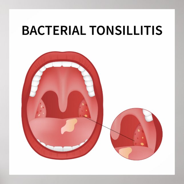 Poster Tossilite bacteriana (Frente)