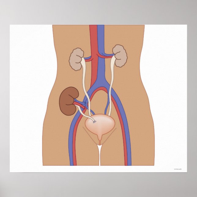 Póster Transplante renal (Frente)