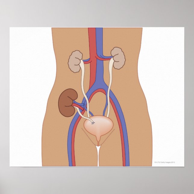 Póster Transplante renal (Frente)