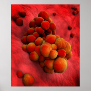 Póster Vista microscópica do tumor 2