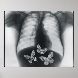 Póster X-ray of butterflies in the stomach