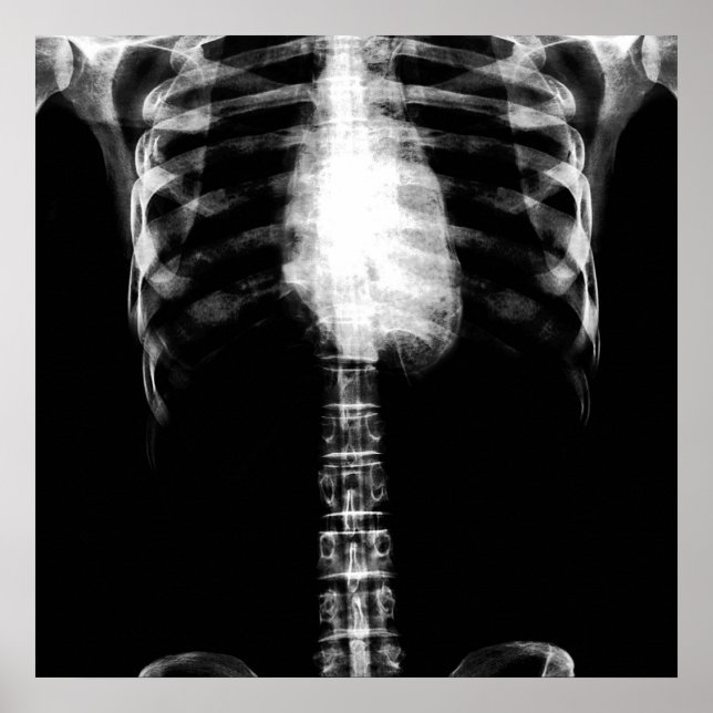 PÓSTER X RAY SKELETON TORSO RIBS - B&W (Frente)