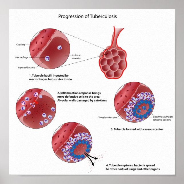 Progressão do Poster de tuberculose pulmonar (Frente)