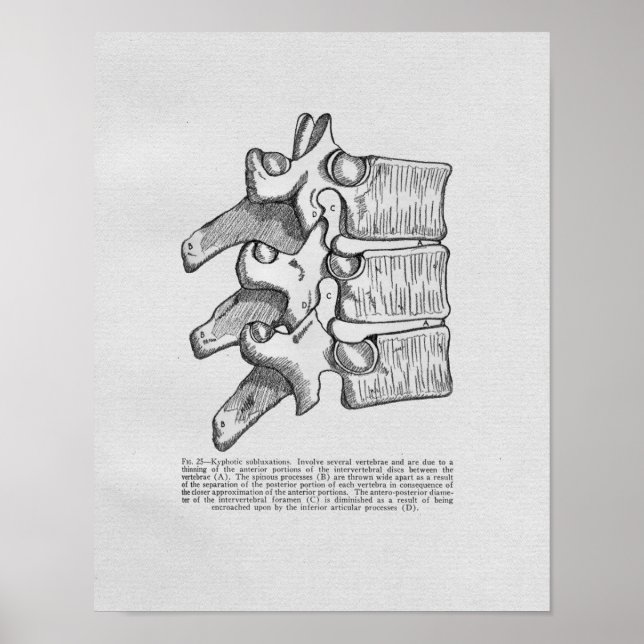 Subluxação Chiropracática Impressão de Vintagem (Frente)