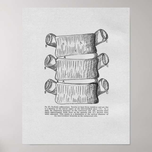 Subluxação Vertebral Quiroprática Impressão (Frente)