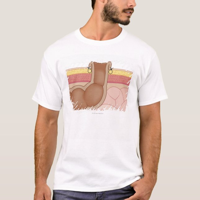 T-shirt Colostomia permanente (Frente)