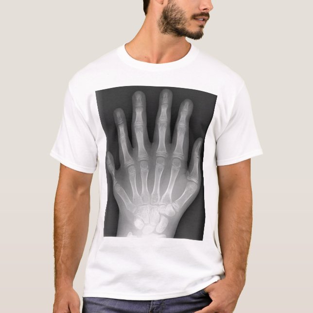 T-shirts Polydactyly, seis mãos apontado, raio X, raridade! (Frente)