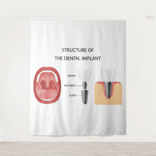Tapete De Parede Estrutura do implante dentário