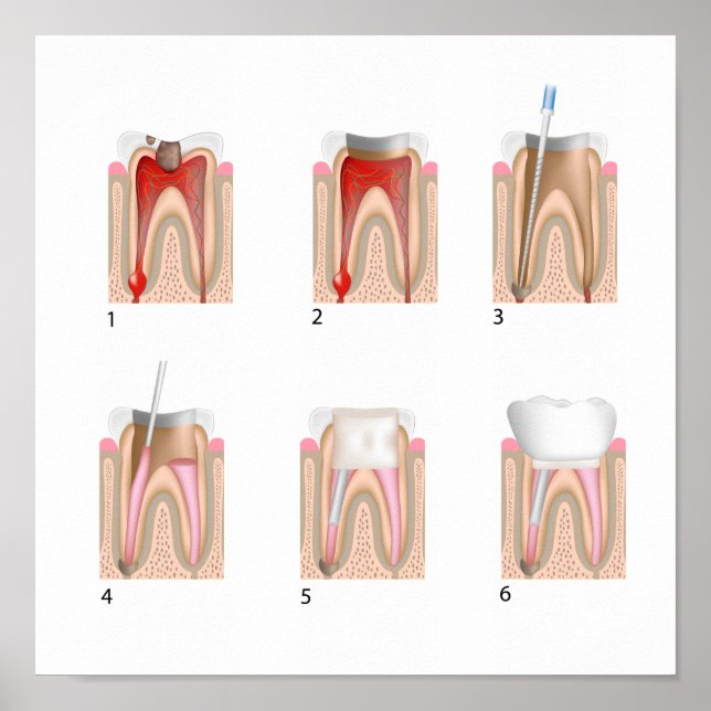 Tratamento do canal da raiz Poster de qualquer tam (Frente)