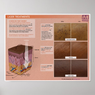 Tratamento por laser melalogico Poster